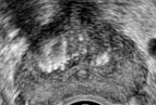Transrectal prostate ultrasound image obtained in the transverse plane demonstrating benign prostate hypertrophy with increased echotexture in the transitional zone