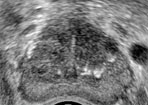 Transrectal Ultrasound image of the prostate obtained in the transverse plane demonstrating enlargement of the transitional z