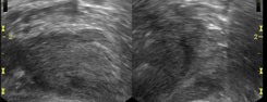 Transrectal prostate ultrasound in the sagittal (right) and transverse (left) planes demonstrating a subtle hypoechoic nodule within the peripheral zone which is suspicious for malignancy