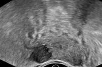 Transrectal ultrasound of the prostate acquired in the transverse plane demonstrates a hypoechoic nodule in the peripheral zone at the apex of the gland, suspicious for malignancy