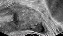 Transrectal Ultrasound of the prostate image obtained in the sagittal plane demonstrating a irregular hypoechoic nodule at the apex of the gland suspicious for malignancy