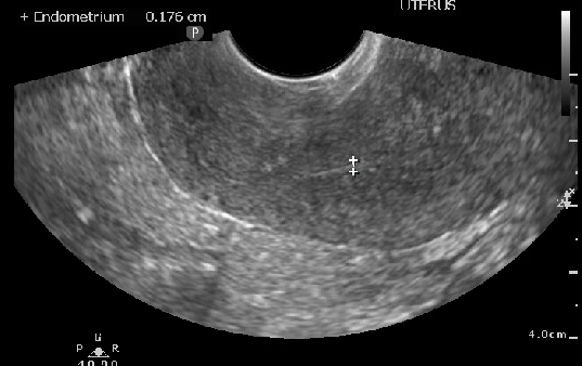 Ultrasound image measuring thin endometrial stripe in postmenopausal patient