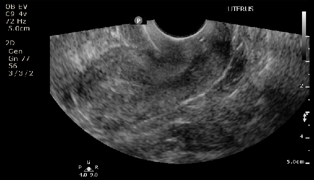 Ultrasound of Postmenopausal patient with thickened endometrial stripe
