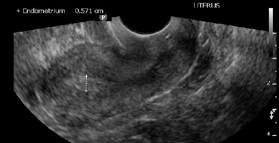 Measuring endometrial stripe in sagittal view of the uterus 