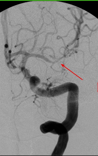 Arteriogram demonstrates left MCA vasospasm, correlating with transcranial Doppler findings.