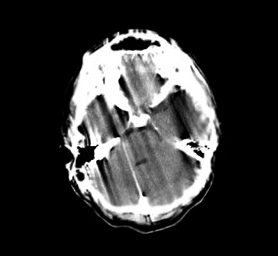 Motion artifact CT scan