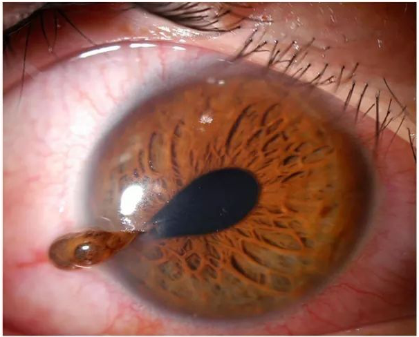 Teardrop pupil with vitreous extrusion in globe rupture.