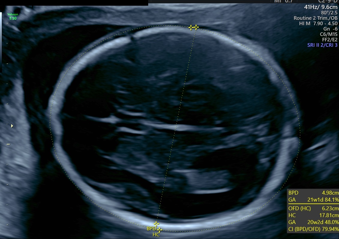 This ultrasound image demonstrates a fetal biparietal diameter and a head circumference in the second trimester with an estimated gestational age of  21 weeks 1 day and 20 weeks 2 days, respectively
