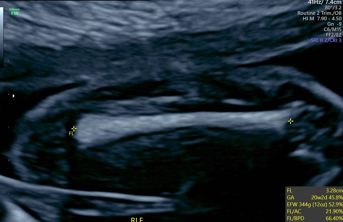 An ultrasound image showing a fetal femur measurement with estimated gestational age of 20 weeks and 2 days.