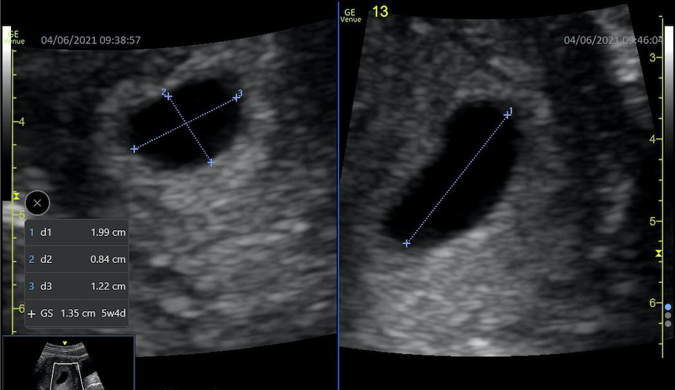 Measurement of this gestational sac in more than one plane helps to determine the gestational age in this ultrasound image.
