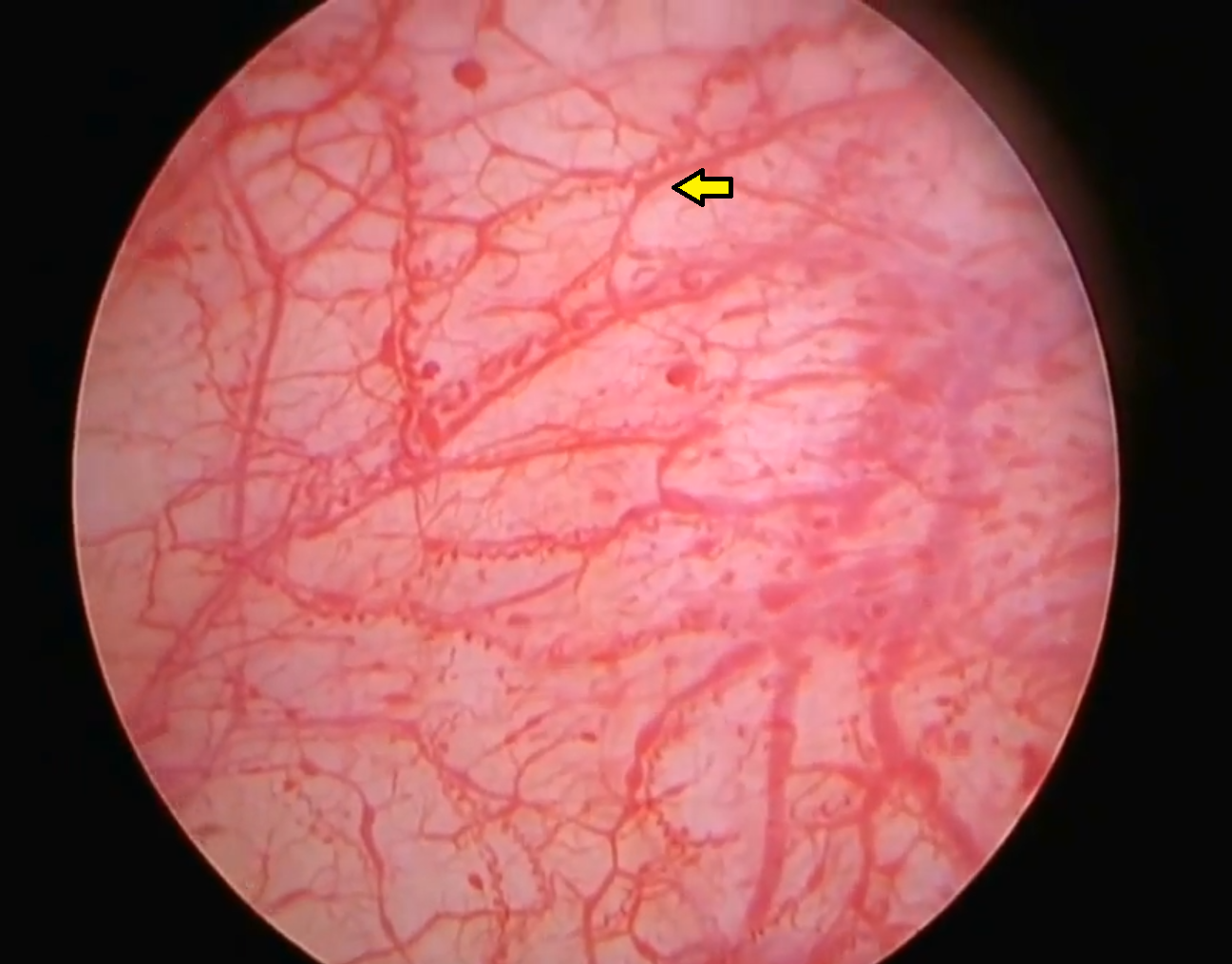 <p>Abnormal Mucosa Wall. This image shows capillary glomerulations.</p>
