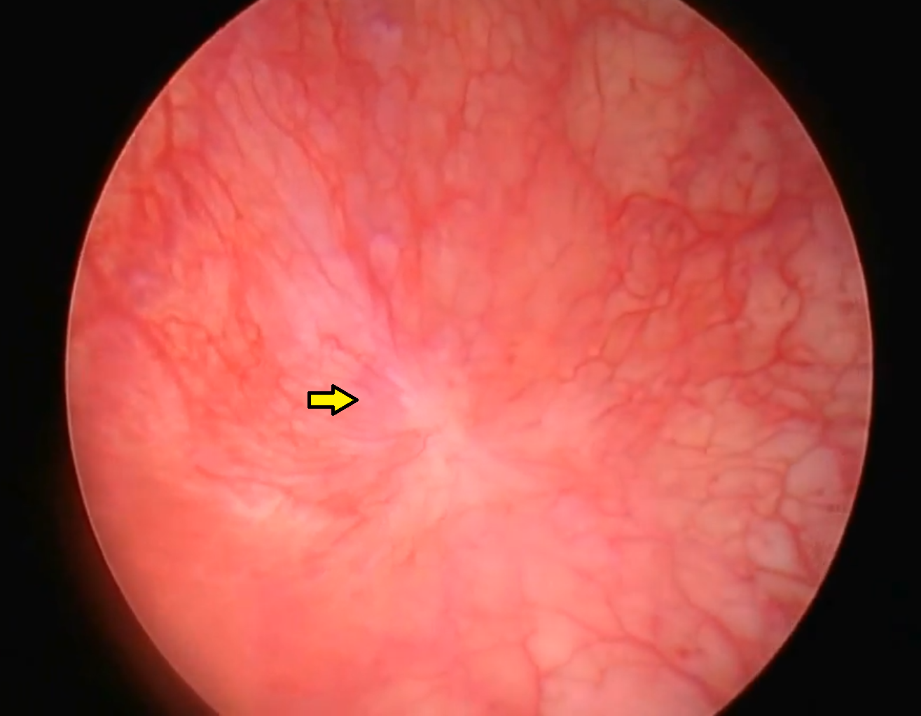 <p>Abnormal Bladder Mucosa, Showing a Hunner Ulcer