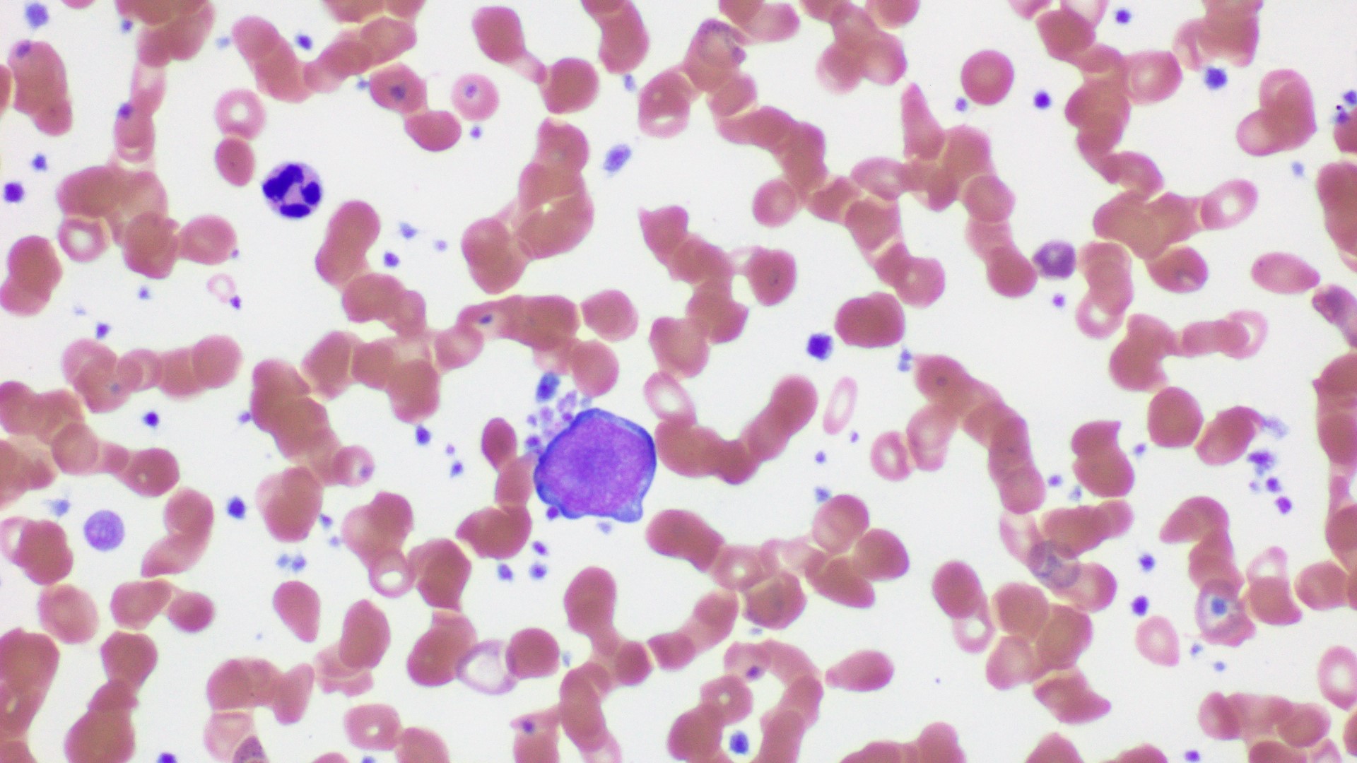 A hematoxylin and eosin (H&E) stained slide showing platelet clumping around a neutrophil. 