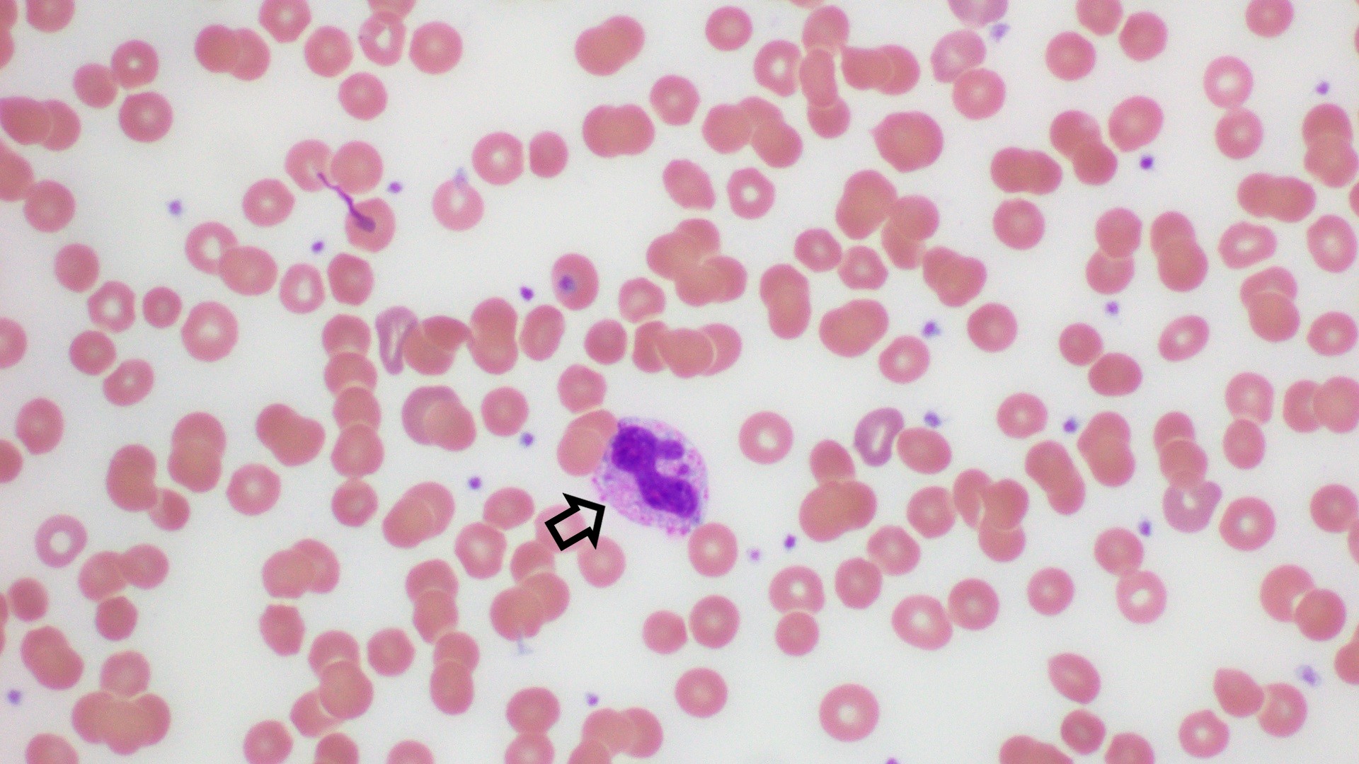 A Hematoxylin and Eosin (H&E) stained slide showing Döhle bodies  that are light blue-gray, oval, basophilic, leukocyte inclusions located in the peripheral cytoplasm of neutrophil (arrow). 