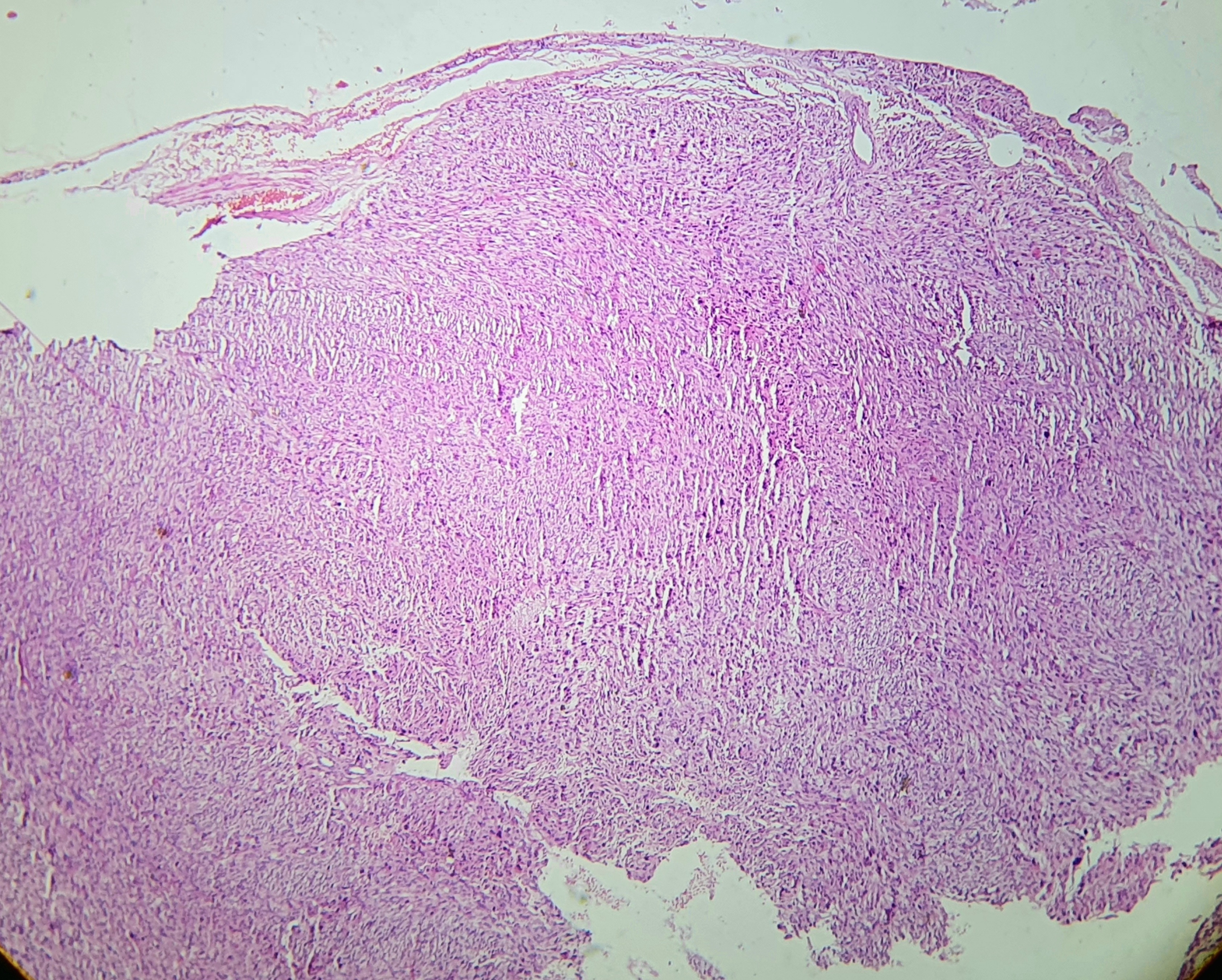Undifferentiated pleomorphic sarcoma. Panoramic view shows an ill-defined dermal neoplasm extending to adipose tissue.