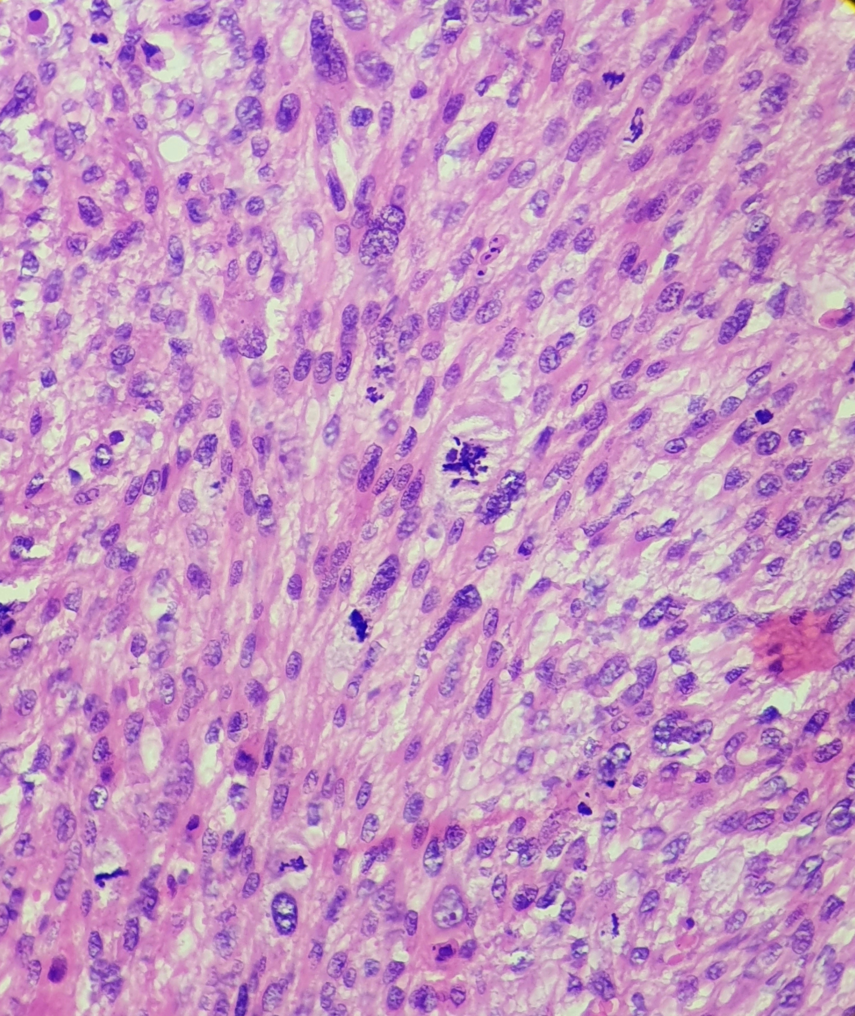 Undifferentiated Pleomorphic Sarcoma. Pleomorphic cells with abundant atypical mitoses. 
