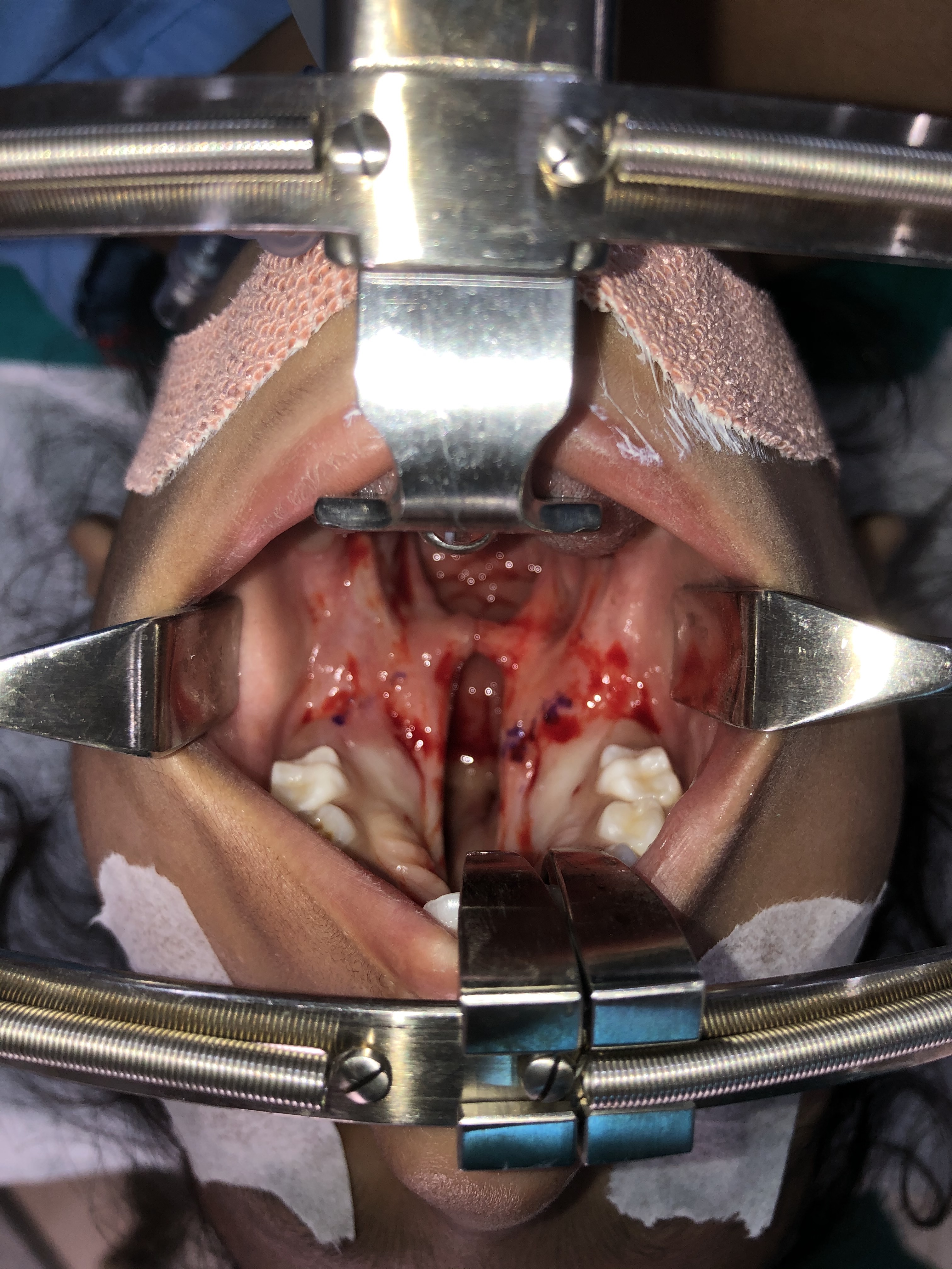 Operative view of a secondary cleft palate involving hard and soft palate