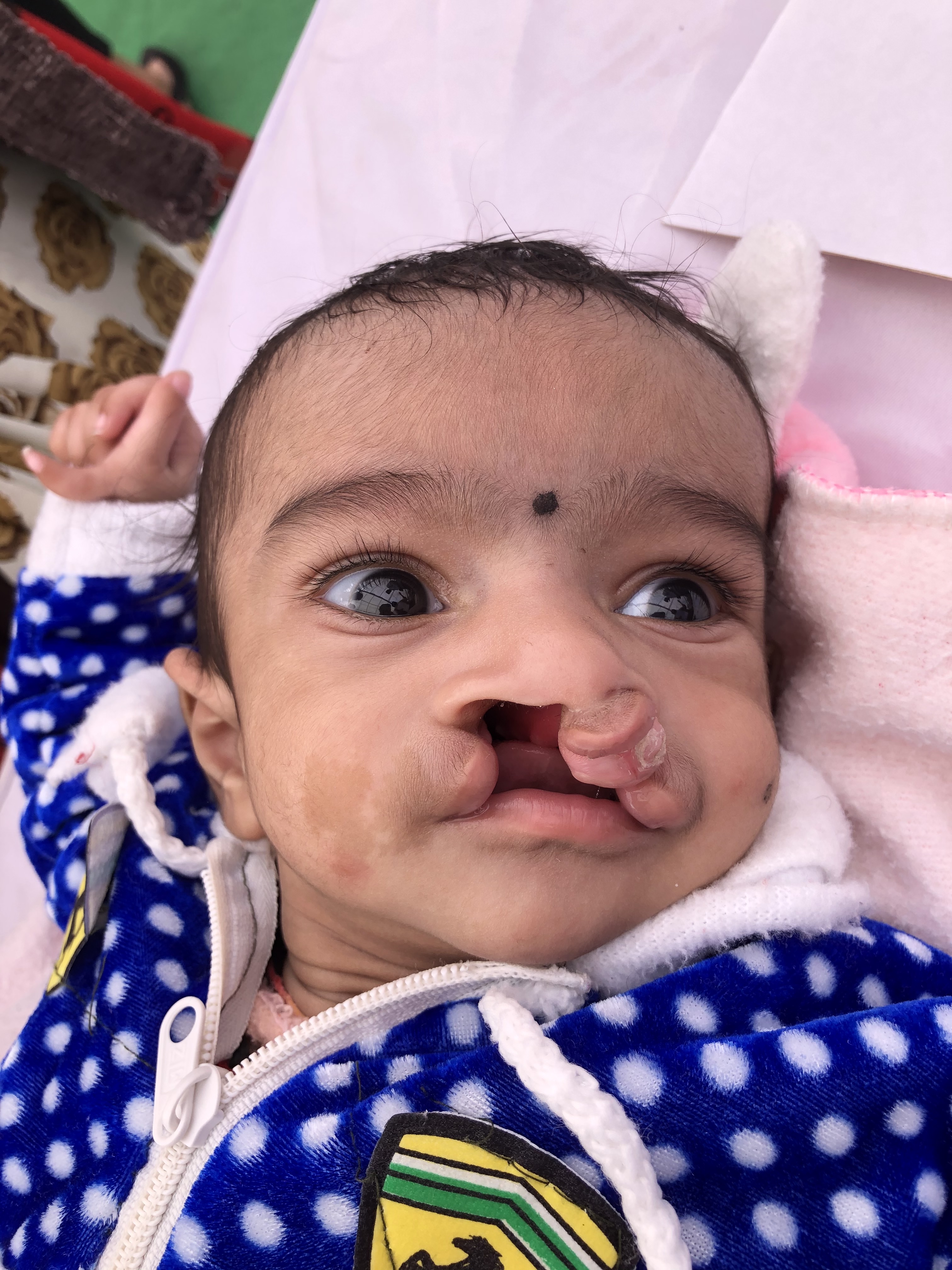 Patient with a bilateral, complete cleft lip and palate. Involves both primary and secondary palate, as well as lip. Note the protuberance of the premaxillary segment.