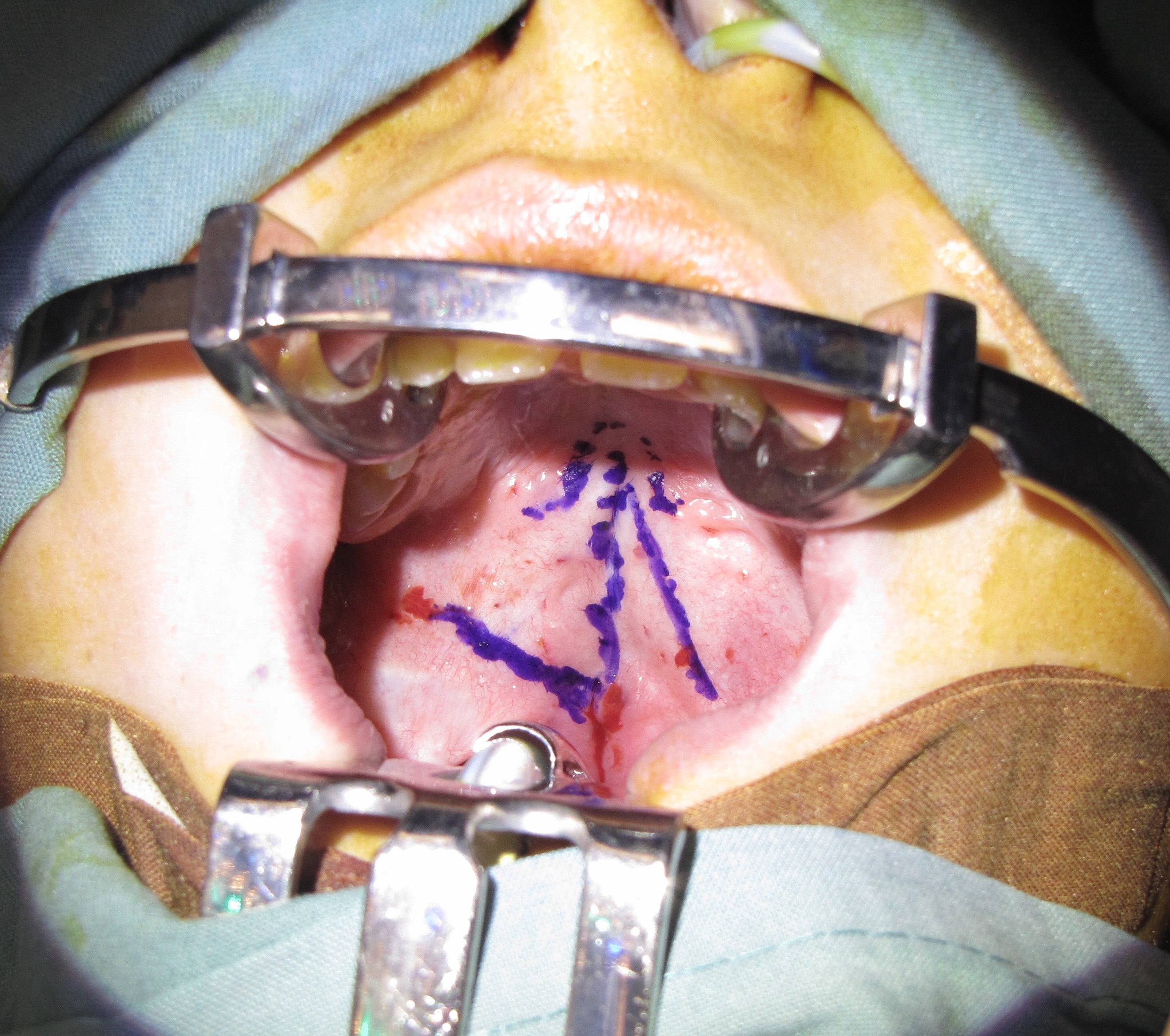 Operative view of a secondary cleft palate involving the soft palate exclusively