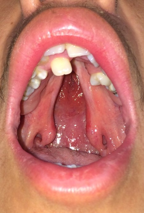 Adolescent patient with an isolated cleft palate involving the hard and soft palate. Preoperative.