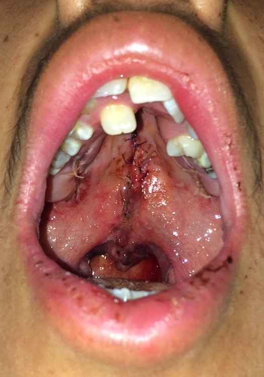 Adolescent patient with an isolated cleft palate involving the hard and soft palate. Postoperative.