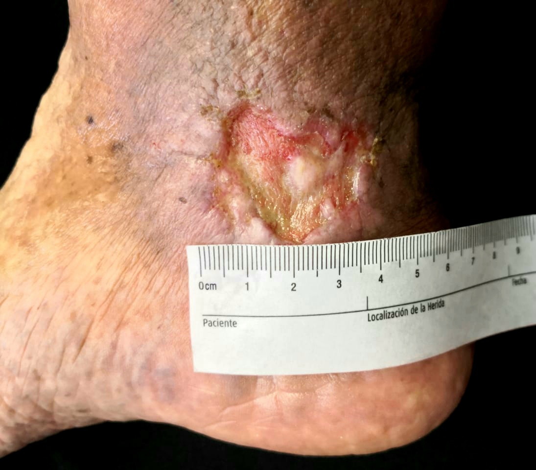 Venous leg ulcer affecting the gaiter area. The base shows considerable slough and scarce granulation tissue. The borders are irregular but well-defined. The surrounding skin shows hyperpigmentation and there is notable leg edema. 