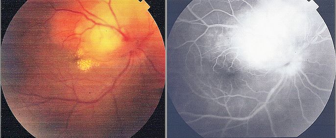 Color photo and fluorescein angiography of a choroidal granuloma (tuberculoma) in a patient with tuberculous uveitis