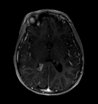 Axial T1 post contrast MRI image of the brain demonstrates leptomeningeal enhancement and enlarged choroid plexus
