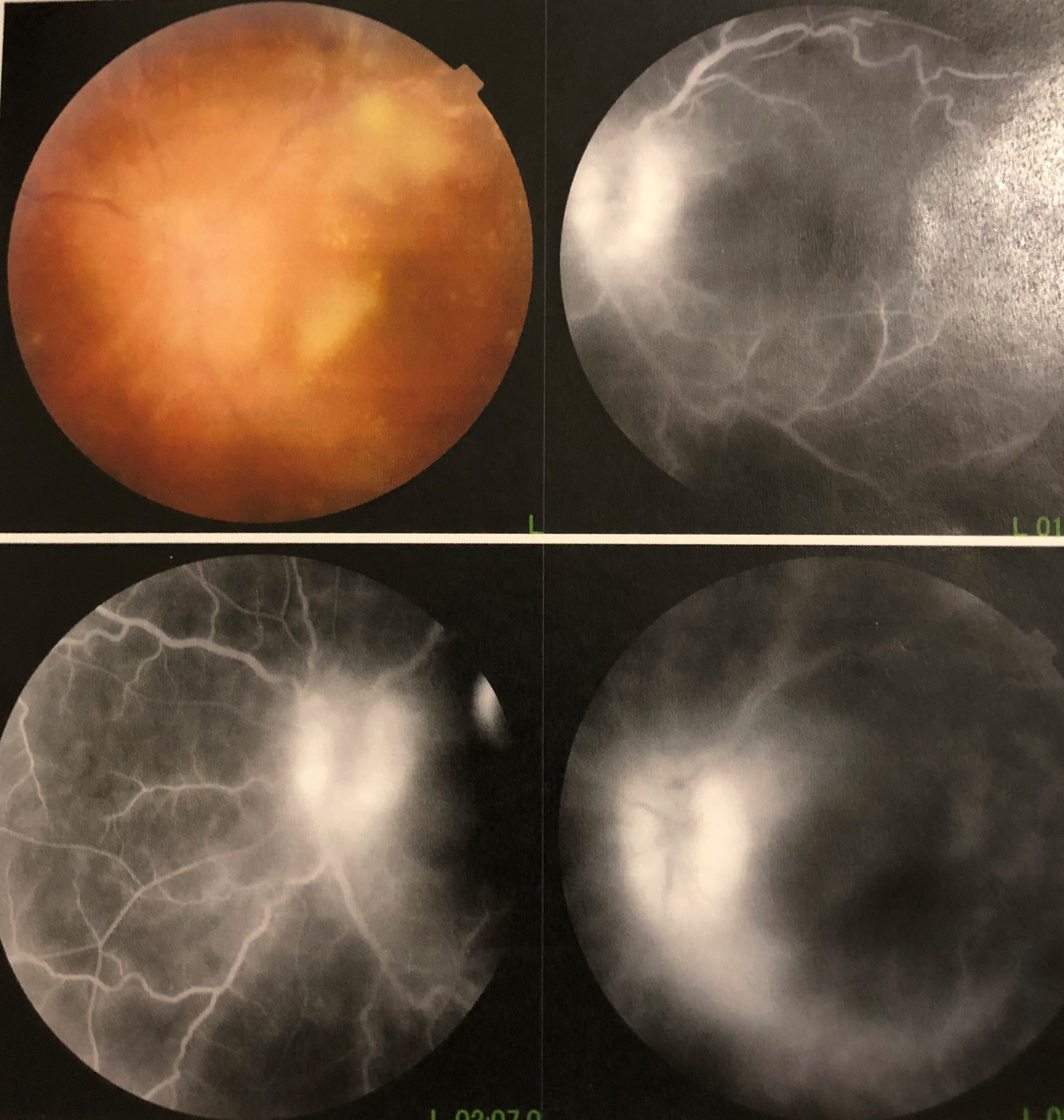 Color photography and fluorescein angiography of a patient with fungal endophthalmitis following coronavirus disease-2019.