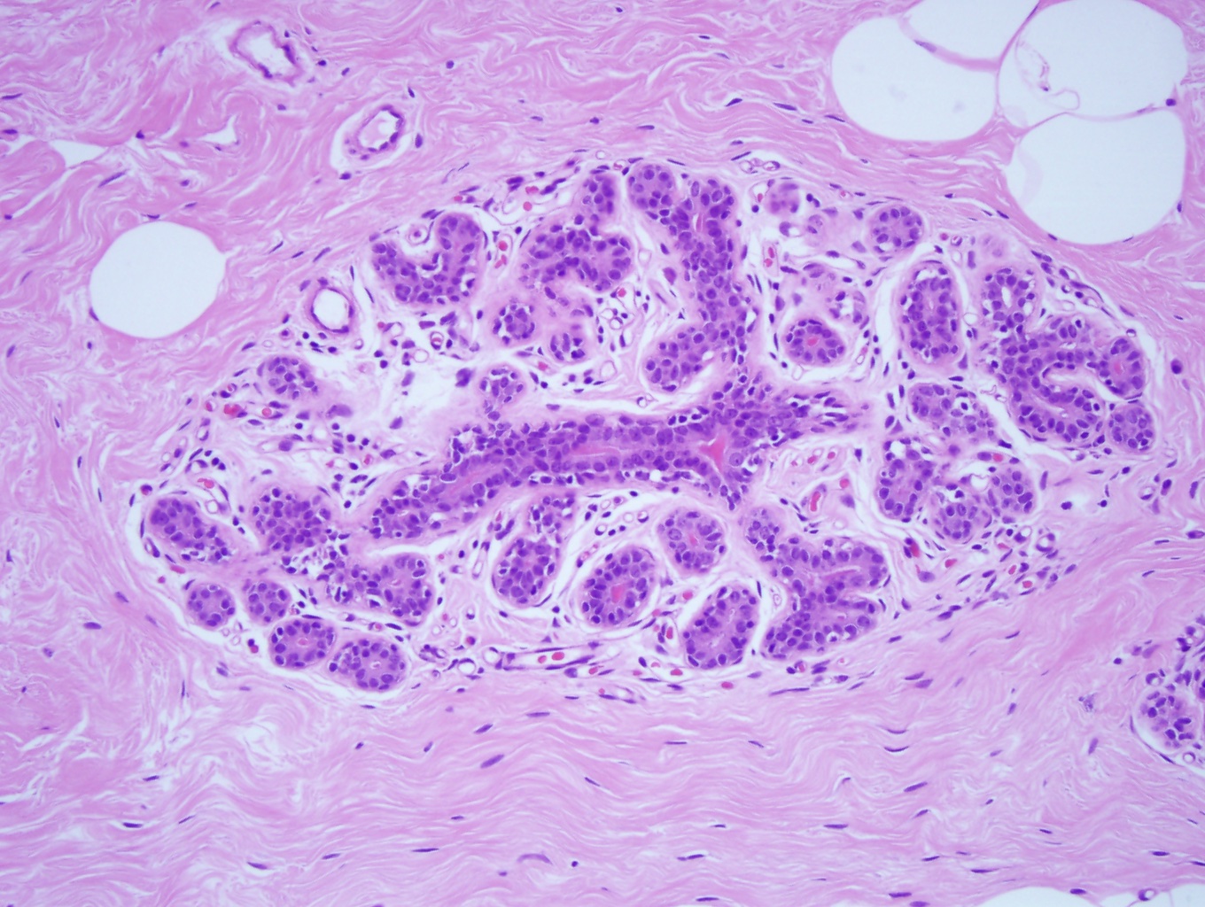 Microscopic anatomy of normal female breast tissue showing a terminal duct lobular unit (TDLU) . The ducts and lobules lumens are open as the epithelial cells do not distend them. Note the epithelial nuclei are overlapping, small, round, and the nucleoli are inconspicuous, consistent with benign breast tissue (x10).