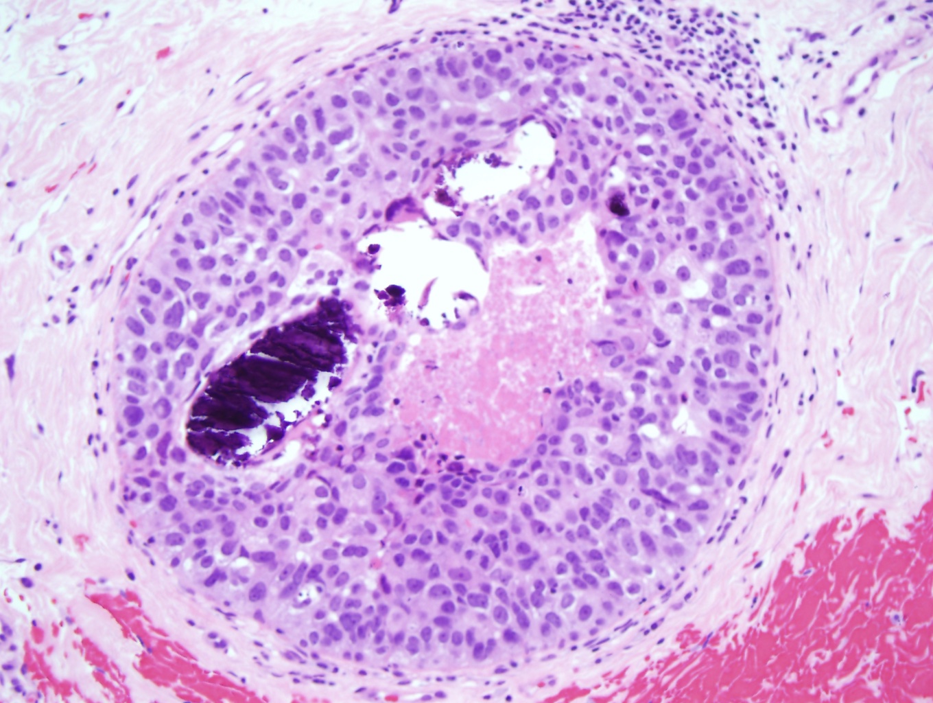 The image shows high grade ductal carcinoma (x10).  There is a proliferation of large, pleomorphic cells with prominent nucleoli. The cells are arranged in a solid pattern with comedo necrosis and calcifications. The cellular proliferation does not breach the myoepithelial cell layer, maintaining its in situ nature. 