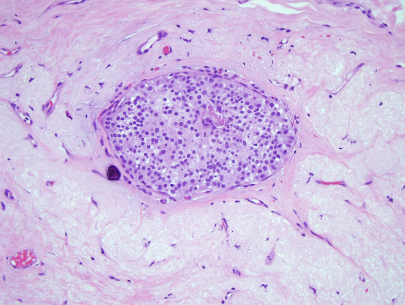 Ductal carcinoma in situ, low grade (x20). The image shows a proliferation of uniform sized round cells, confined to the duct, and without nucleoli or mitosis.  A focal microcalcification is present. The cells are arranged in a solid pattern without necrosis. 