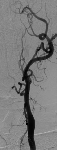 <p>Occlusion of the Internal Carotid Artery (ICA)