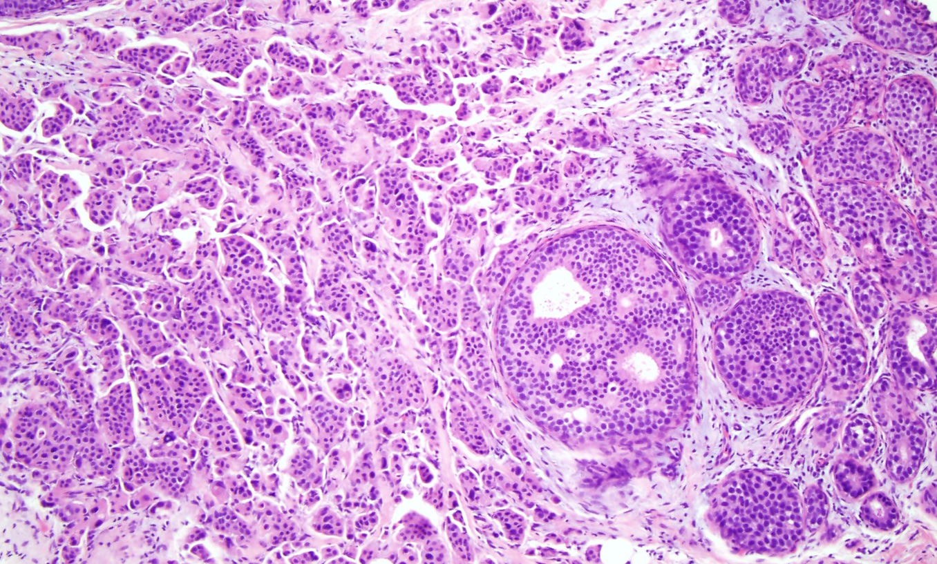 High grade ductal carcinoma in situ with invasive ductal carcinoma (x10). The left side of the image shows sheet of cells with pleomorphic nuclei, arranged in tubules, infiltrating into the breast stroma, consistent with invasive ductal carcinoma that originated from the adjacent high grade ductal carcinoma in situ in the right side of the image. 
