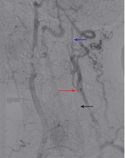 An example of collateralization in a patient with left common carotid artery (CCA) occlusion. The left CCA is occluded (black arrow). There is filling of the left external carotid artery (ECA) via collaterals, and the left carotid bifurcation fills via the ECA (red arrow). The distal left internal carotid artery (ICA) then fills antegrade (blue arrow).