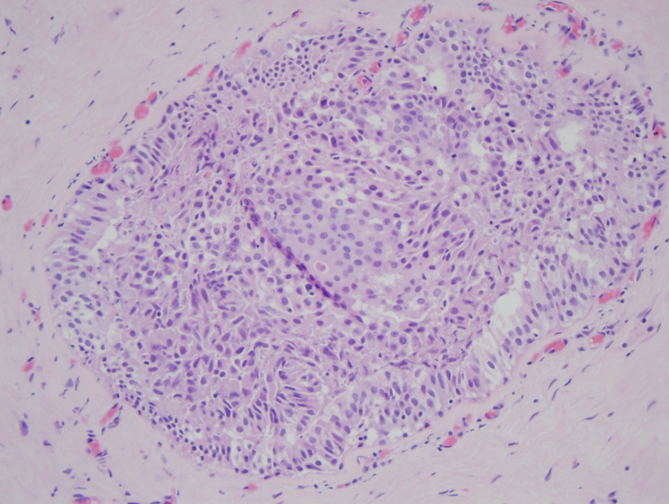 Atypical ductal hyperplasia (ADH) (x20). In the middle of the duct is a proliferation of organized atypical epithelial cells with round, monomorphic, and uniform nuclei, consistent with ADH.  The remainder of the duct is filled with a haphazard organization of epithelial cells with overlapping nuclei that are variable in shape and size, consistent with usual ductal hyperplasia (UDH), a benign epithelial cellular proliferation. 