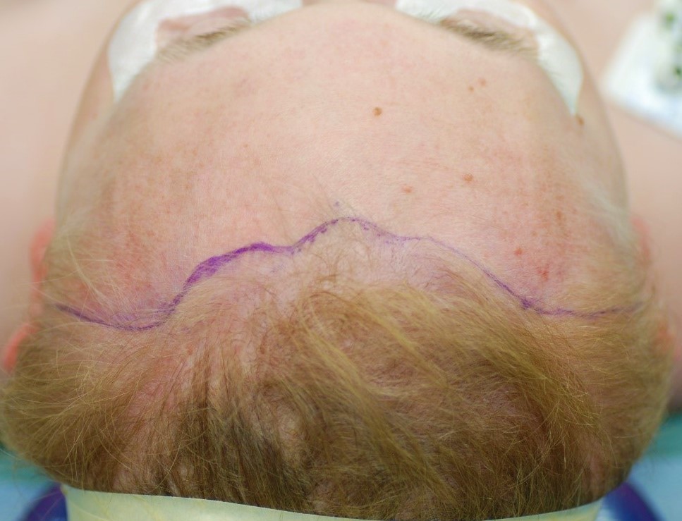 Preoperative marking of the pretrichial brow lift incision. Note how it follows the frontal hairline centrally and dives into the temporal hair tufts laterally.