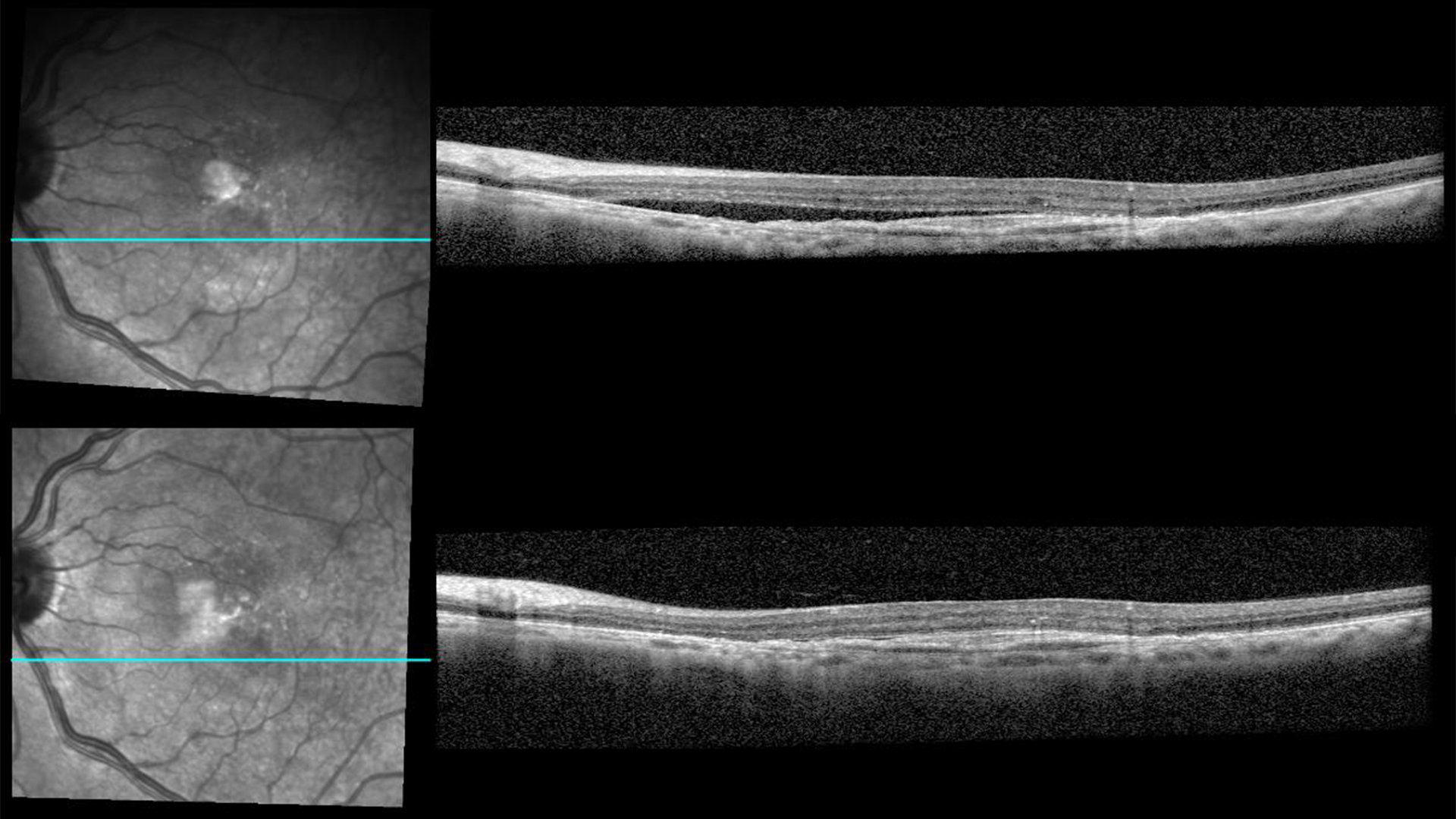 Optical coherence tomography (OCT) image of an eye before (top) and four weeks after (bottom) intravitreal aflibercept injection