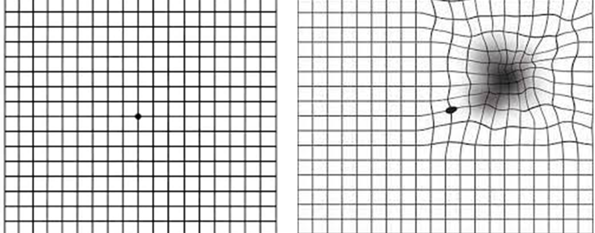 Amsler grid as seen by a normal eye (left) and one with wet age-related macular degeneration (ARMD) (right), demonstrating distortion and a paracentral scotoma