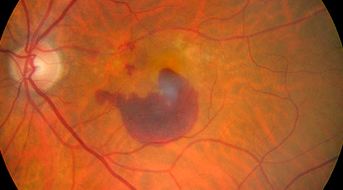 Fundus photo of a left eye demonstrating drusen with a submacular hemorrhage, a complication of wet (exudative or neovascular) age-related macular degeneration