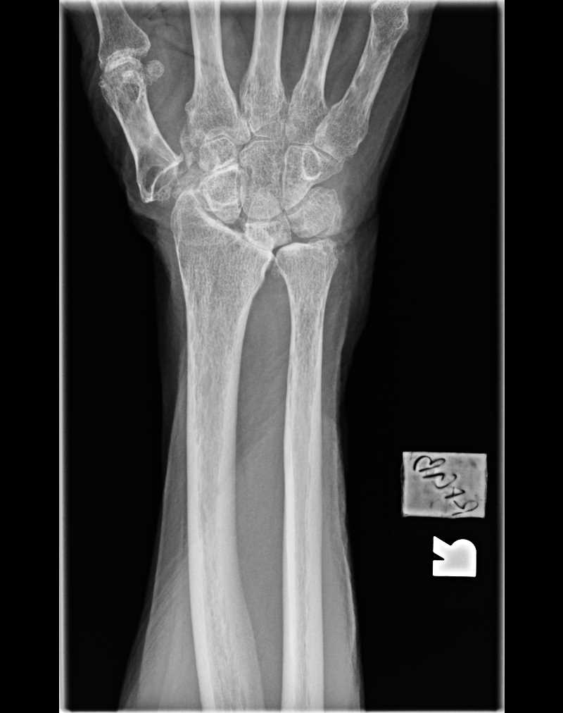 Radiograph Wrist SLAC wrist (Scapholunate Advanced Collapse) Madelung Deformity