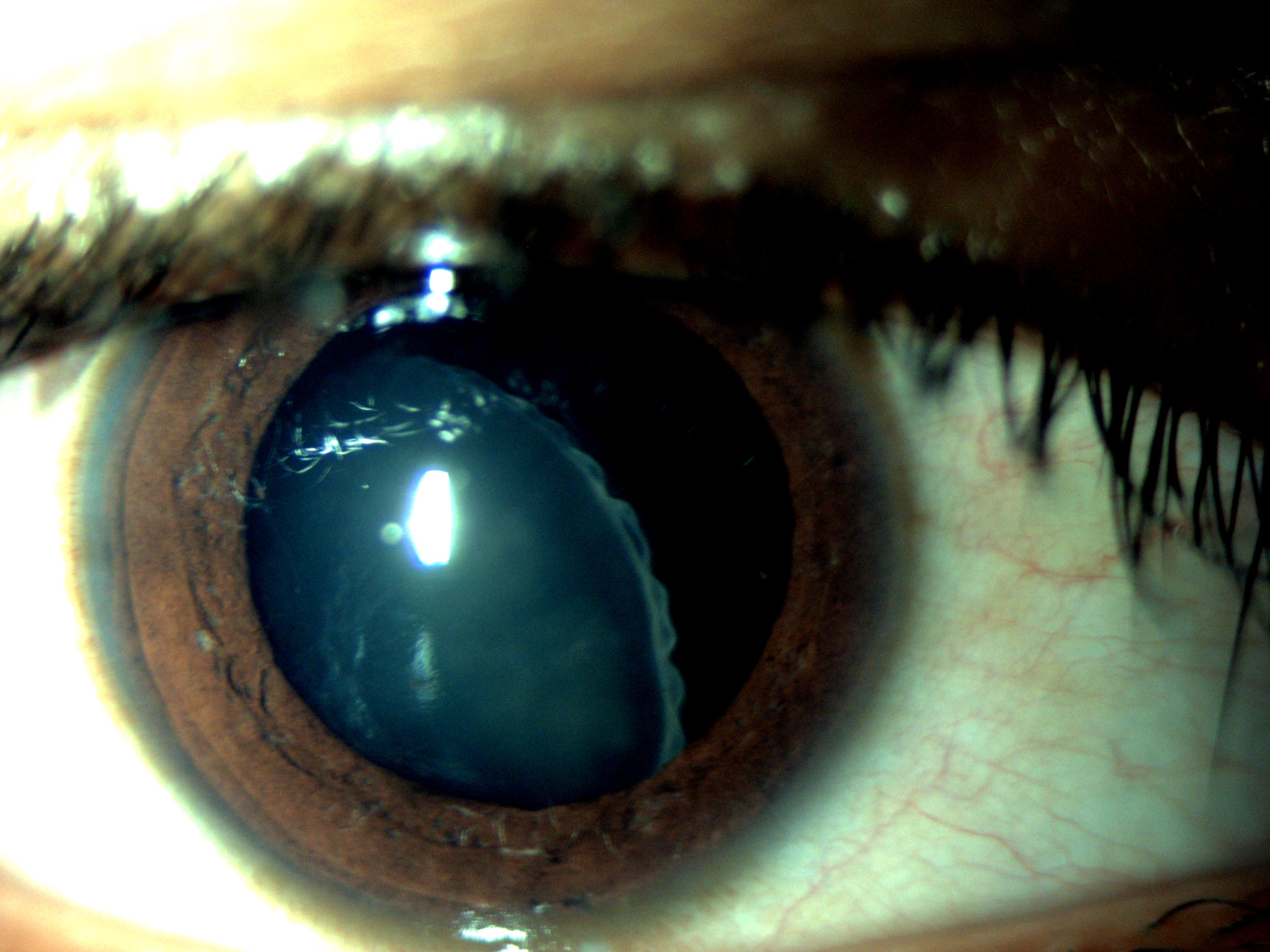 Subluxated crystalline lens (ectopia lentis)