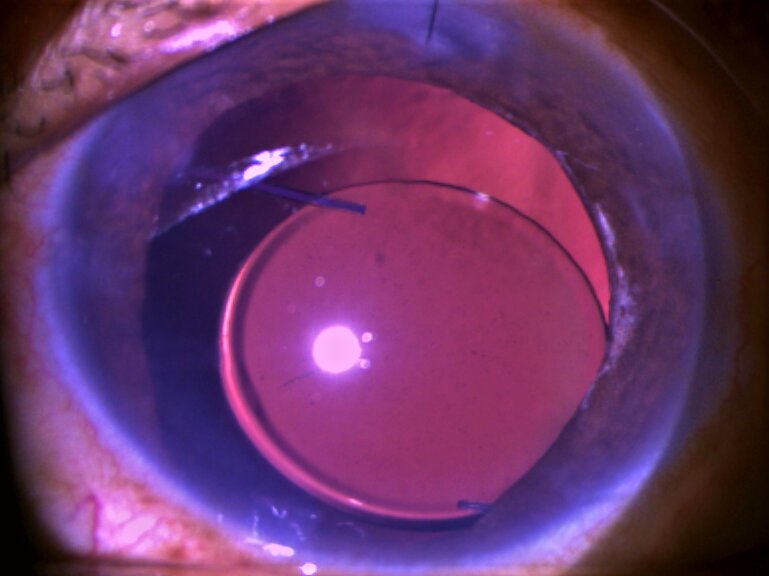 Decentered IOL presenting a few weeks after scleral fixation of IOL.
