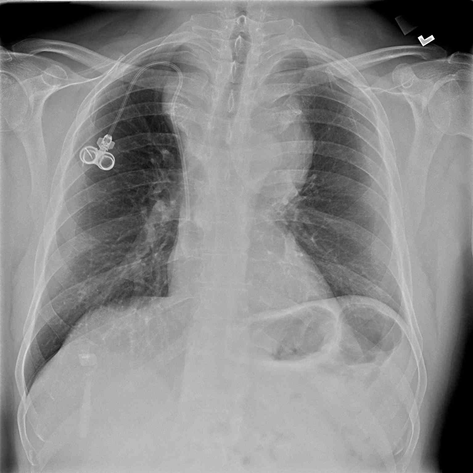 <p>Periapical (PA) Chest Radiograph, Anterior Mediastinal Mass Diff: Thymus, Thyroid, Teratoma, or Terrible Lymphoma</p>