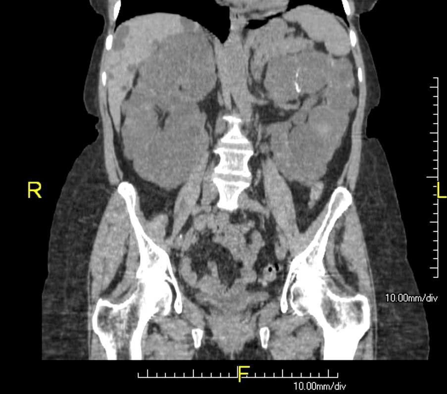 CT Abdomen Autosomal Dominant Polycystic Kidney Disease