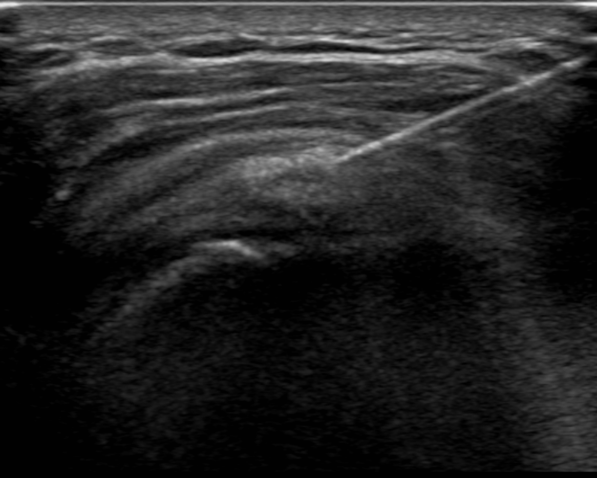 Ultrasound-guided barbotage of the supraspinatus tendon.