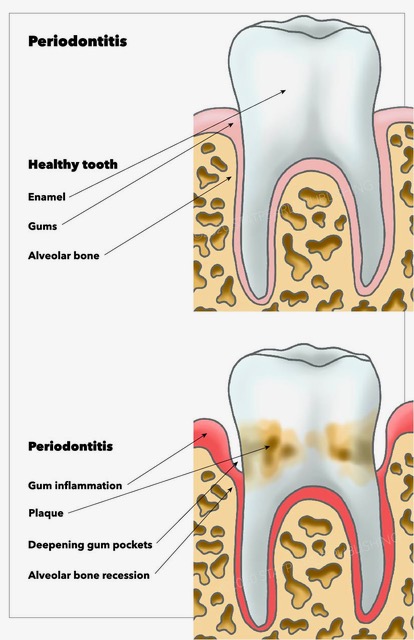 Periodontitis, enamel, gums, alveolar bone, plaque, bone recession, gum pockets