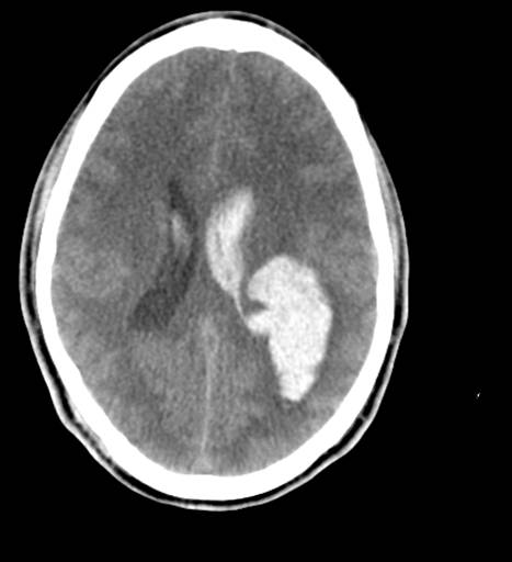 CT head Intraventricular and Intraparenchymal Hemorrhage From AVM