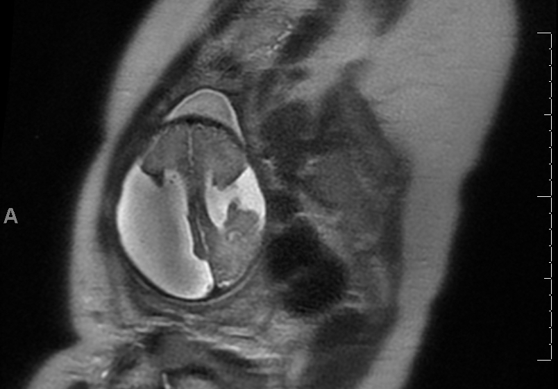 Maternal MRI Bilateral Open Lip Schizencephaly