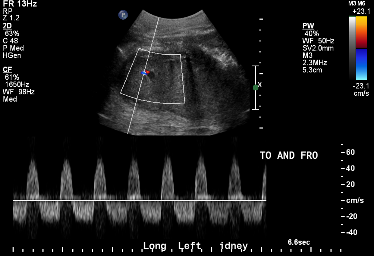 Spectral Doppler shows "To-and-fro" waveform associated with a pseudoaneurysm 